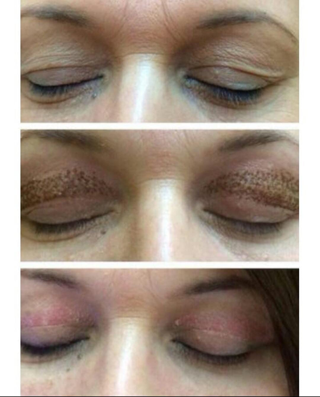 Blefaroplastia com Jato de Plasma