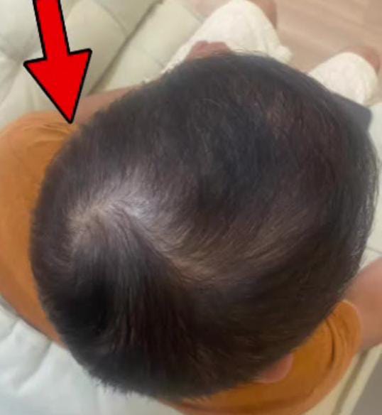 Antes do procedimento 3