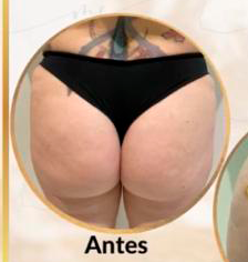 Antes Protocolo harmonização glútea