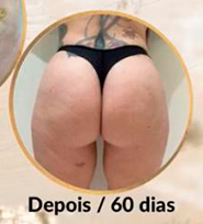 Depois do Protocolo harmonização glútea