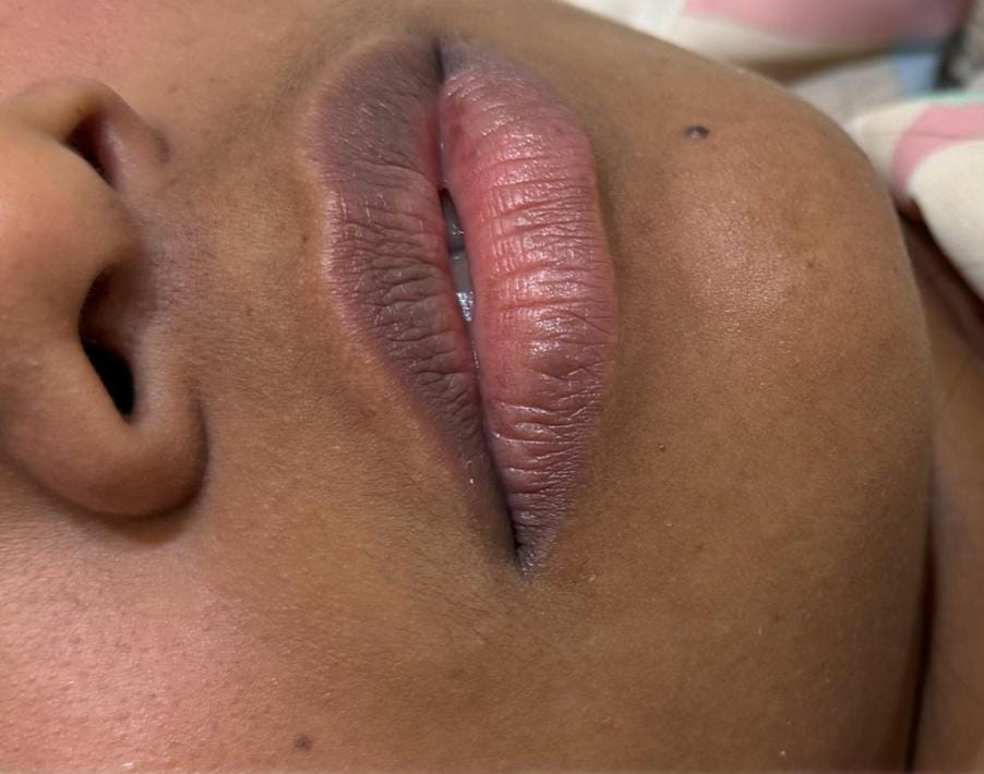 Antes do procedimento 1