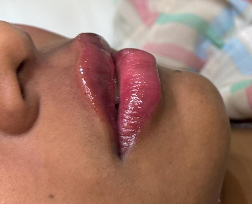 Preenchimento Labial