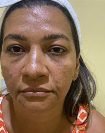 Antes Protocolo Botox + preenchimento labial + preenchimento do sulco nasogeniano ( bigode chinês) + limpeza de pele coreana