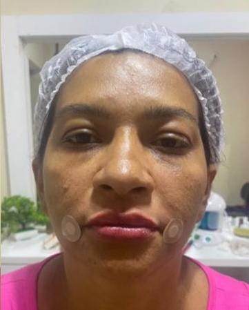 Depois do Protocolo Botox + preenchimento labial + preenchimento do sulco nasogeniano ( bigode chinês) + limpeza de pele coreana