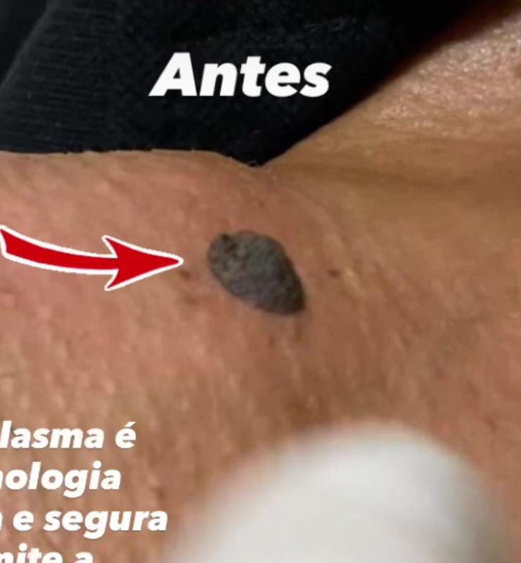 Antes do procedimento 3